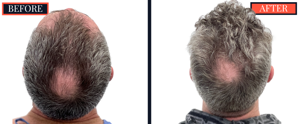FUE Hair Transplant - 1773 grafts