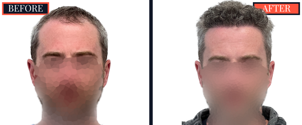 FUE Hair Transplant - 1773 grafts