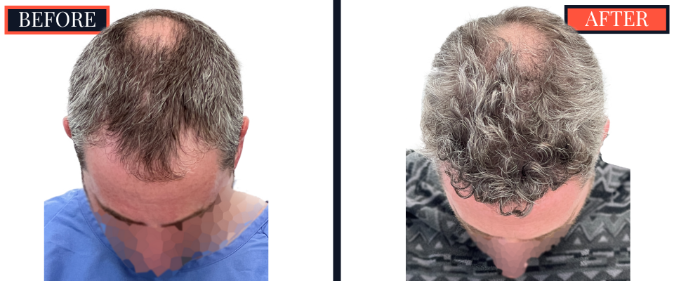FUE Hair Transplant - 1773 grafts