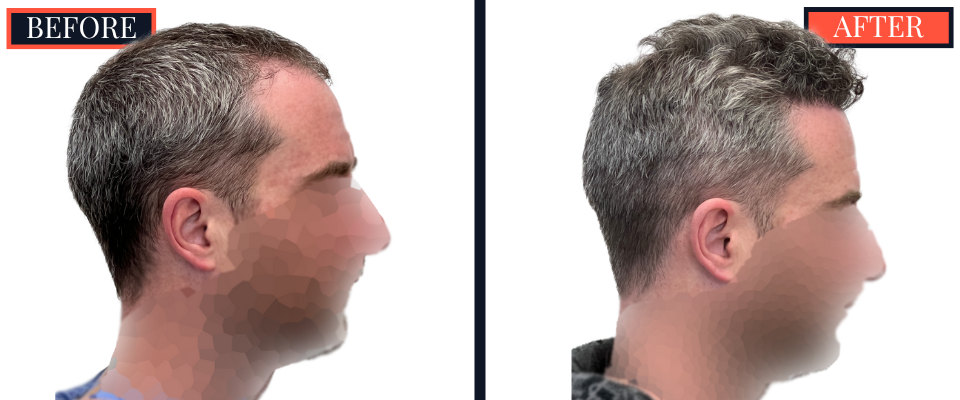 FUE Hair Transplant - 1773 grafts