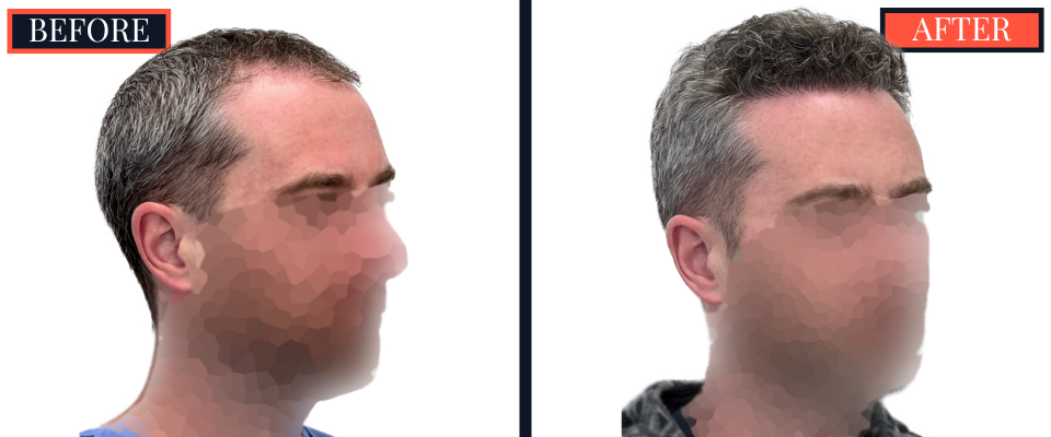 FUE Hair Transplant - 1773 grafts