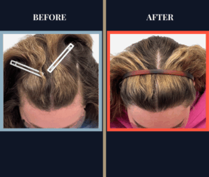 2030 graft fut female hair transplant surgery results