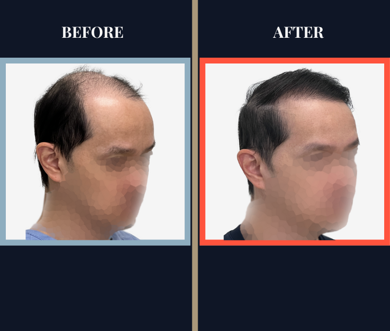 2059 GRAFT FUT/STRIP Hair Transplant