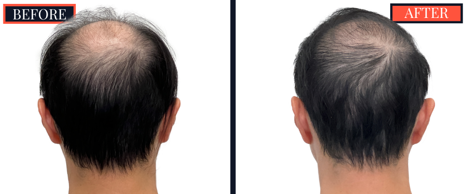 2059 GRAFT FUT/STRIP Hair Transplant