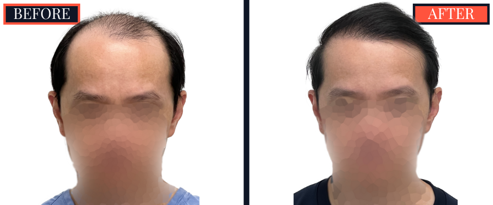 2059 GRAFT FUT/STRIP Hair Transplant
