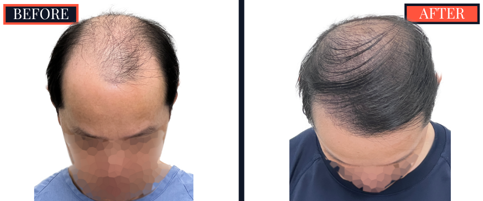 2059 GRAFT FUT/STRIP Hair Transplant
