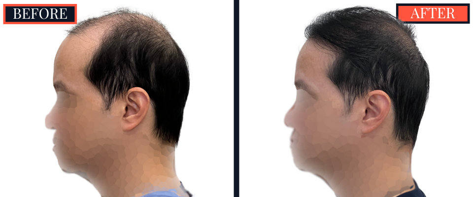 2059 GRAFT FUT/STRIP Hair Transplant