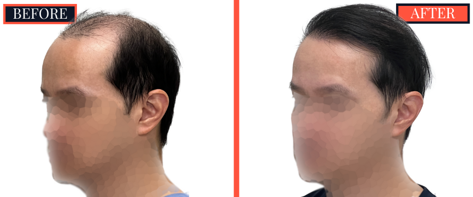 2059 GRAFT FUT/STRIP Hair Transplant