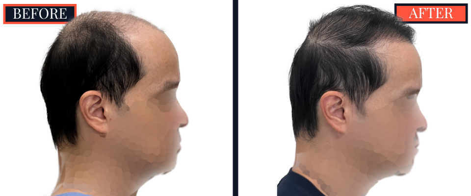 2059 GRAFT FUT/STRIP Hair Transplant