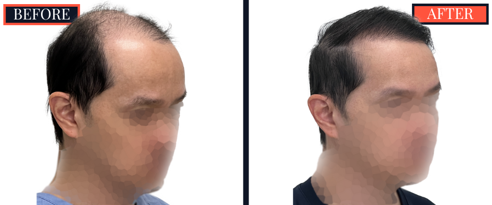 2059 GRAFT FUT/STRIP Hair Transplant