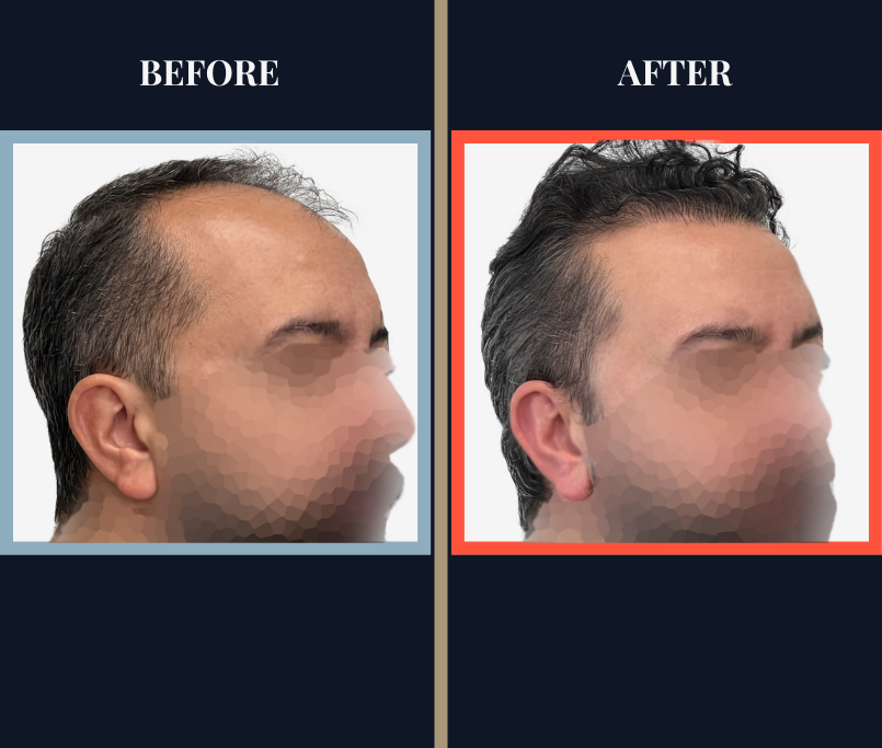 2207 GRAFT FUE HAIR TRANSPLANT POST-OP RESULTS
