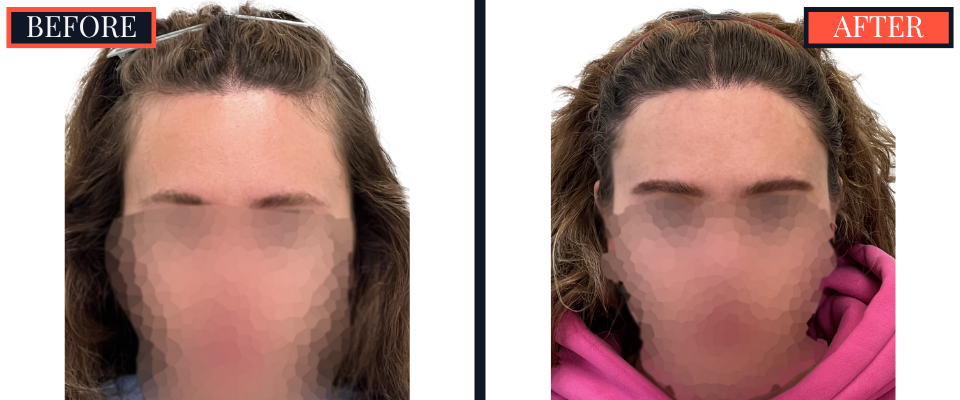 2030 graft fut female hair transplant surgery results