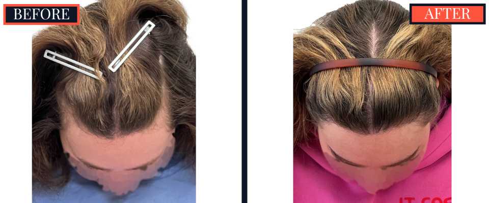 2030 graft fut female hair transplant surgery results