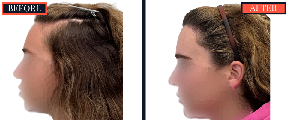 2030 graft fut female hair transplant surgery results