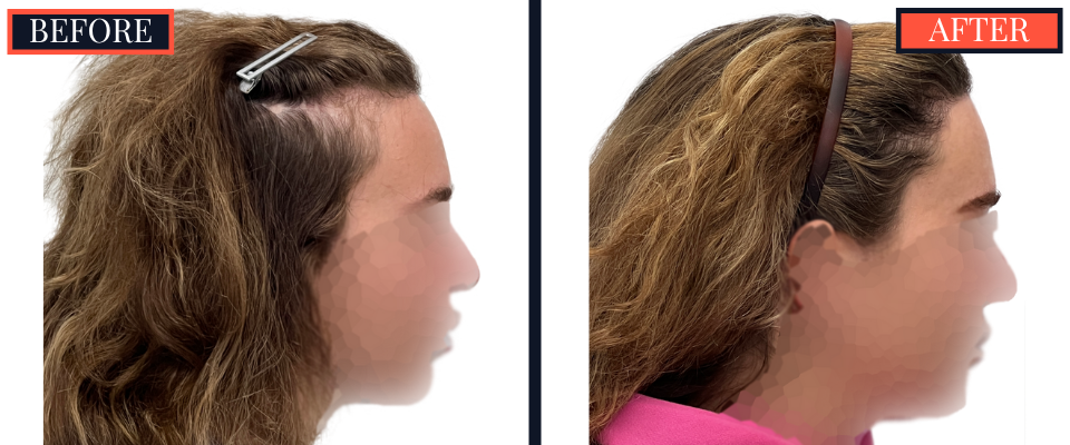 2030 graft fut female hair transplant surgery results