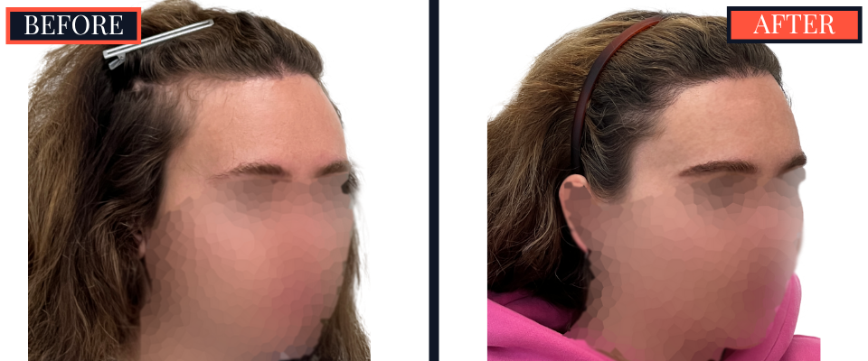 2030 graft fut female hair transplant surgery results