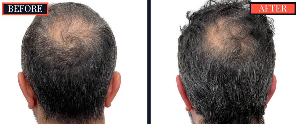 2207 GRAFT FUE HAIR TRANSPLANT POST-OP RESULTS