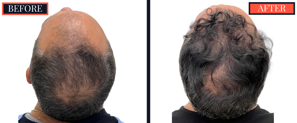 2207 GRAFT FUE HAIR TRANSPLANT POST-OP RESULTS
