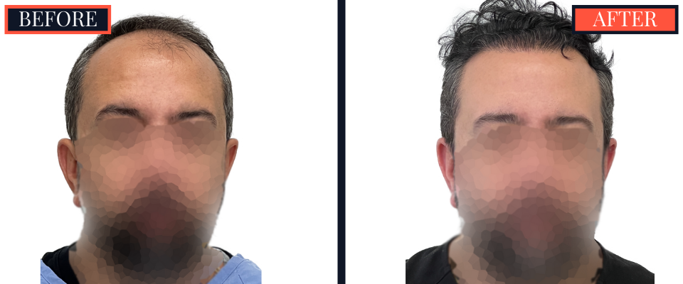 2207 GRAFT FUE HAIR TRANSPLANT POST-OP RESULTS