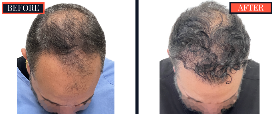 2207 GRAFT FUE HAIR TRANSPLANT POST-OP RESULTS