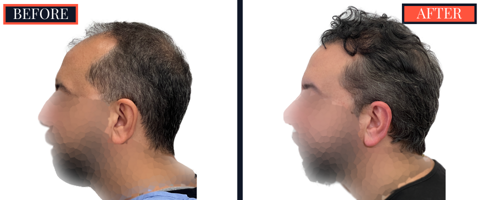 2207 GRAFT FUE HAIR TRANSPLANT POST-OP RESULTS