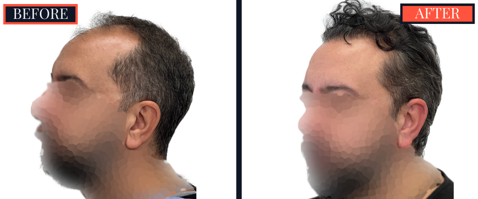2207 GRAFT FUE HAIR TRANSPLANT POST-OP RESULTS