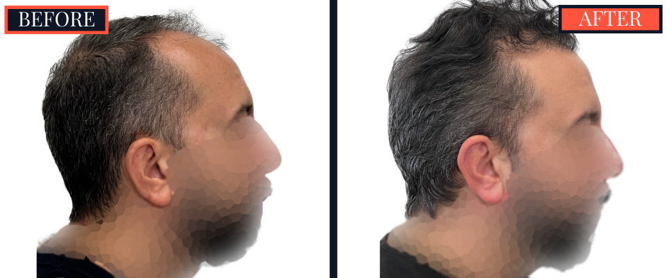 2207 GRAFT FUE HAIR TRANSPLANT POST-OP RESULTS