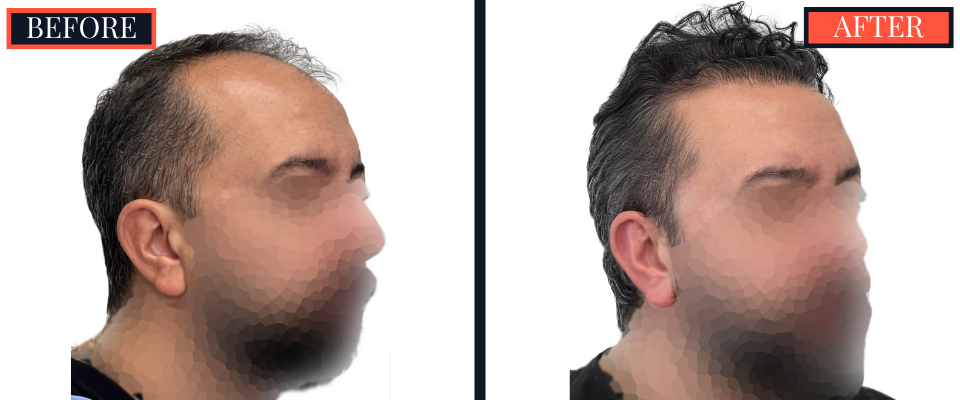 2207 GRAFT FUE HAIR TRANSPLANT POST-OP RESULTS
