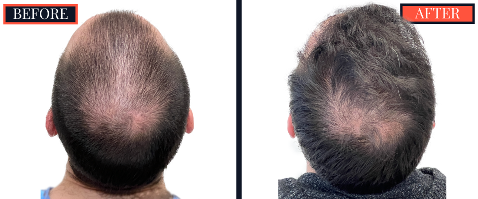 2703 graft FUE hair transplant 1 yr post-op results