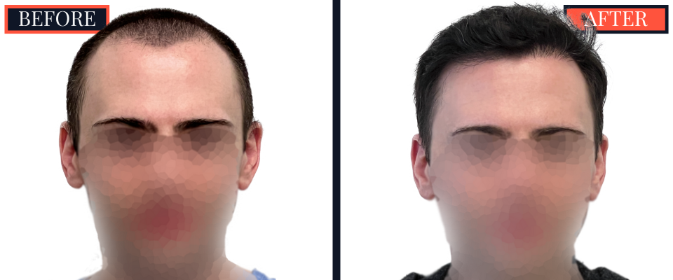 2703 graft FUE hair transplant 1 yr post-op results