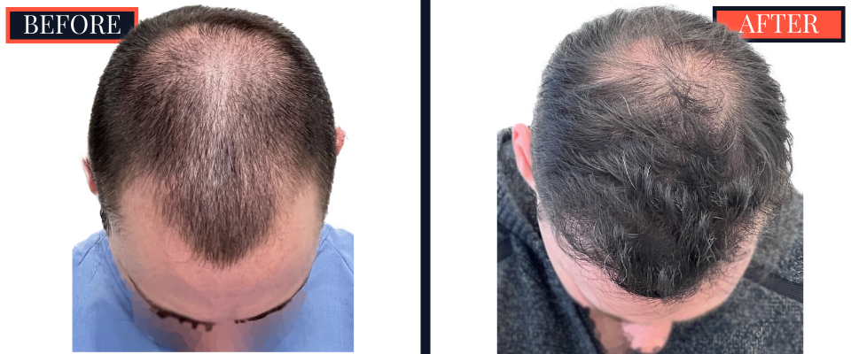 2703 graft FUE hair transplant 1 yr post-op results