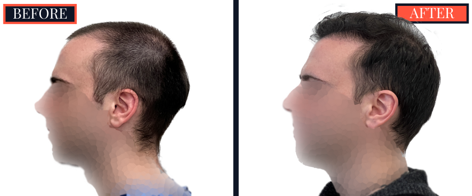 2703 graft FUE hair transplant 1 yr post-op results