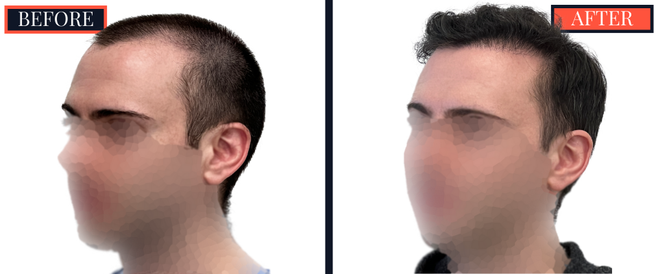 2703 graft FUE hair transplant 1 yr post-op results