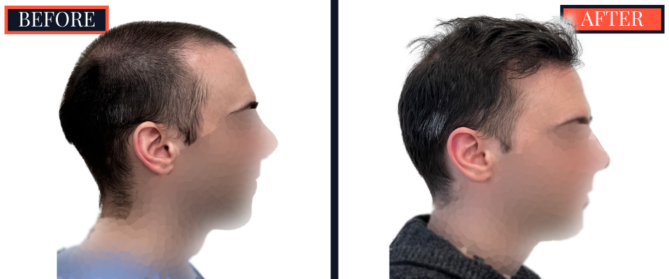 2703 graft FUE hair transplant 1 yr post-op results