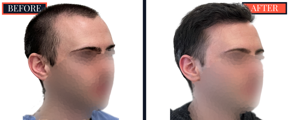 2703 graft FUE hair transplant 1 yr post-op results