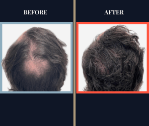 3111 graft FUE hair Transplant - 1 YR post-op