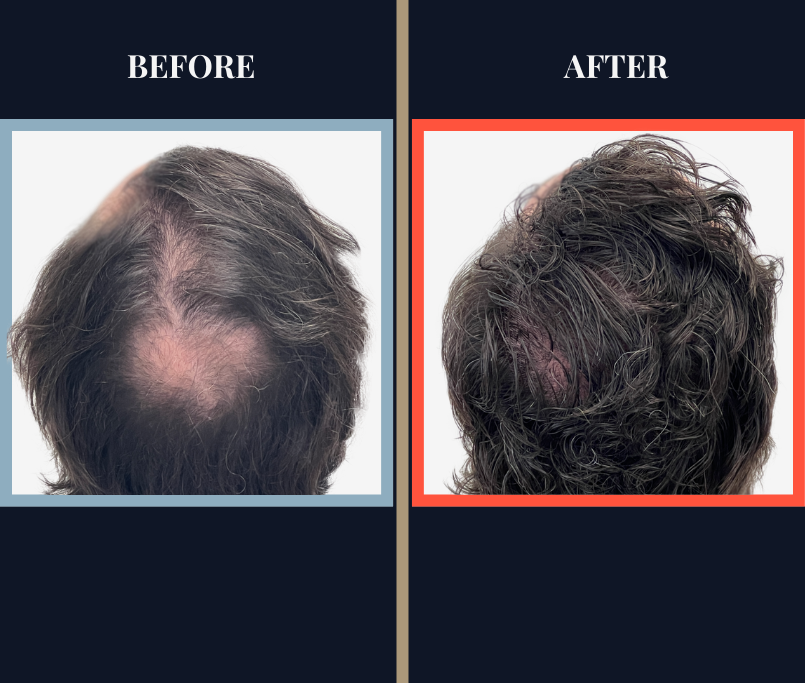3111 graft FUE hair Transplant - 1 YR post-op