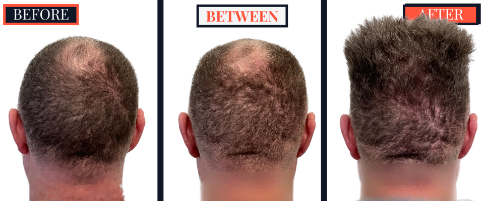 FUE Hair Transplant - Two Surgeries - 3417 grafts