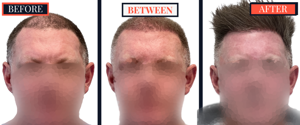 FUE Hair Transplant - Two Surgeries - 3417 grafts