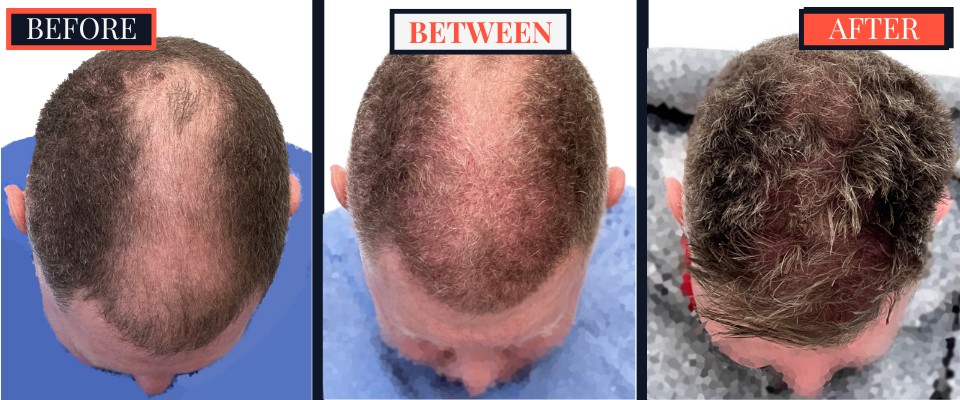 FUE Hair Transplant - Two Surgeries - 3417 grafts