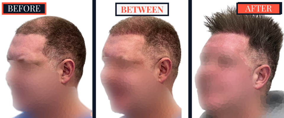 FUE Hair Transplant - Two Surgeries - 3417 grafts