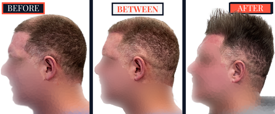 FUE Hair Transplant - Two Surgeries - 3417 grafts