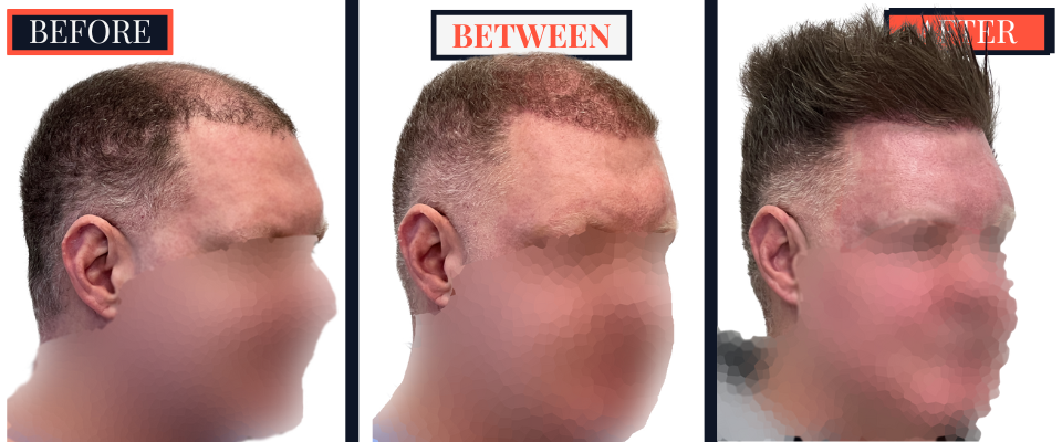 FUE Hair Transplant - Two Surgeries - 3417 grafts