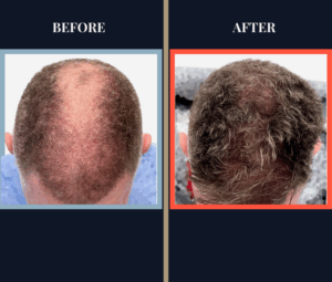 FUE Hair Transplant - Two Surgeries - 3417 grafts