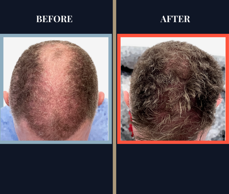 FUE Hair Transplant - Two Surgeries - 3417 grafts