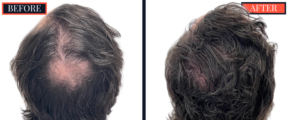 3111 graft FUE hair Transplant - 1 YR post-op