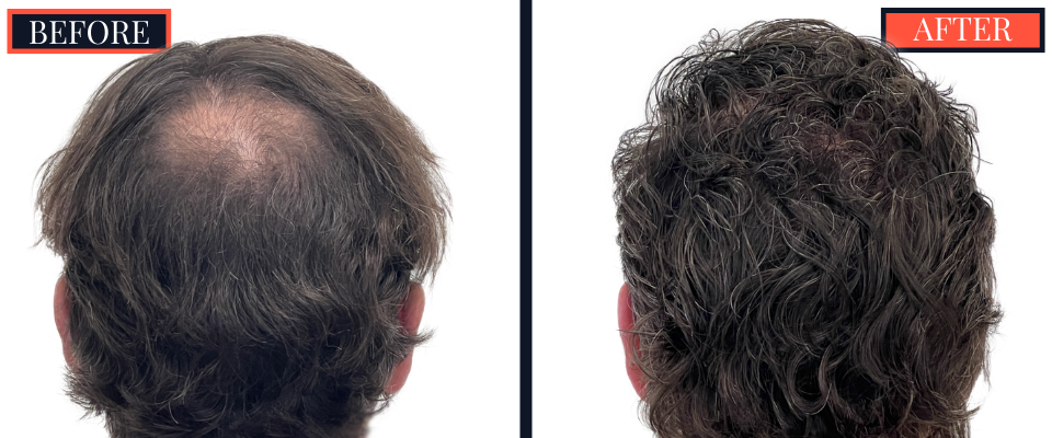3111 graft FUE hair Transplant - 1 YR post-op