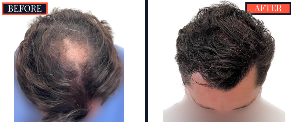 3111 graft FUE hair Transplant - 1 YR post-op