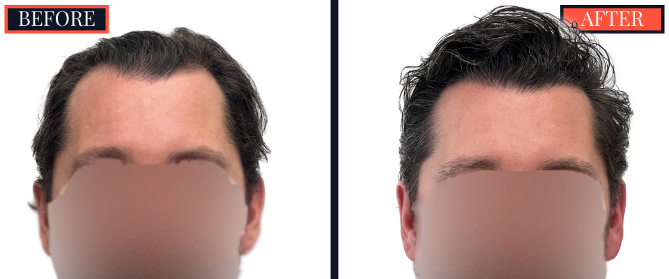 3111 graft FUE hair Transplant - 1 YR post-op