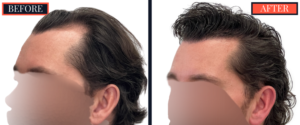 3111 graft FUE hair Transplant - 1 YR post-op